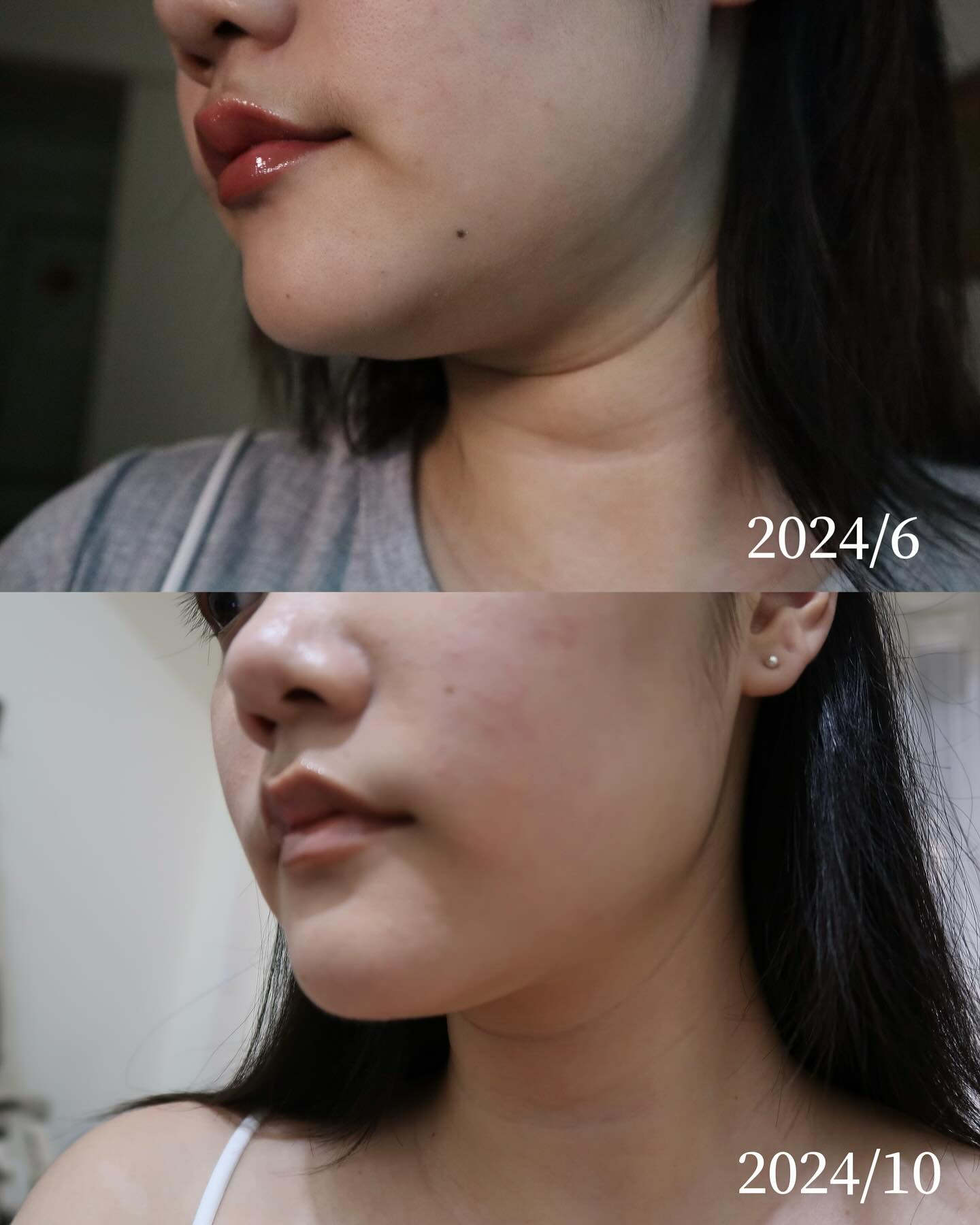 晶翎美學診所海芙音波案例分享