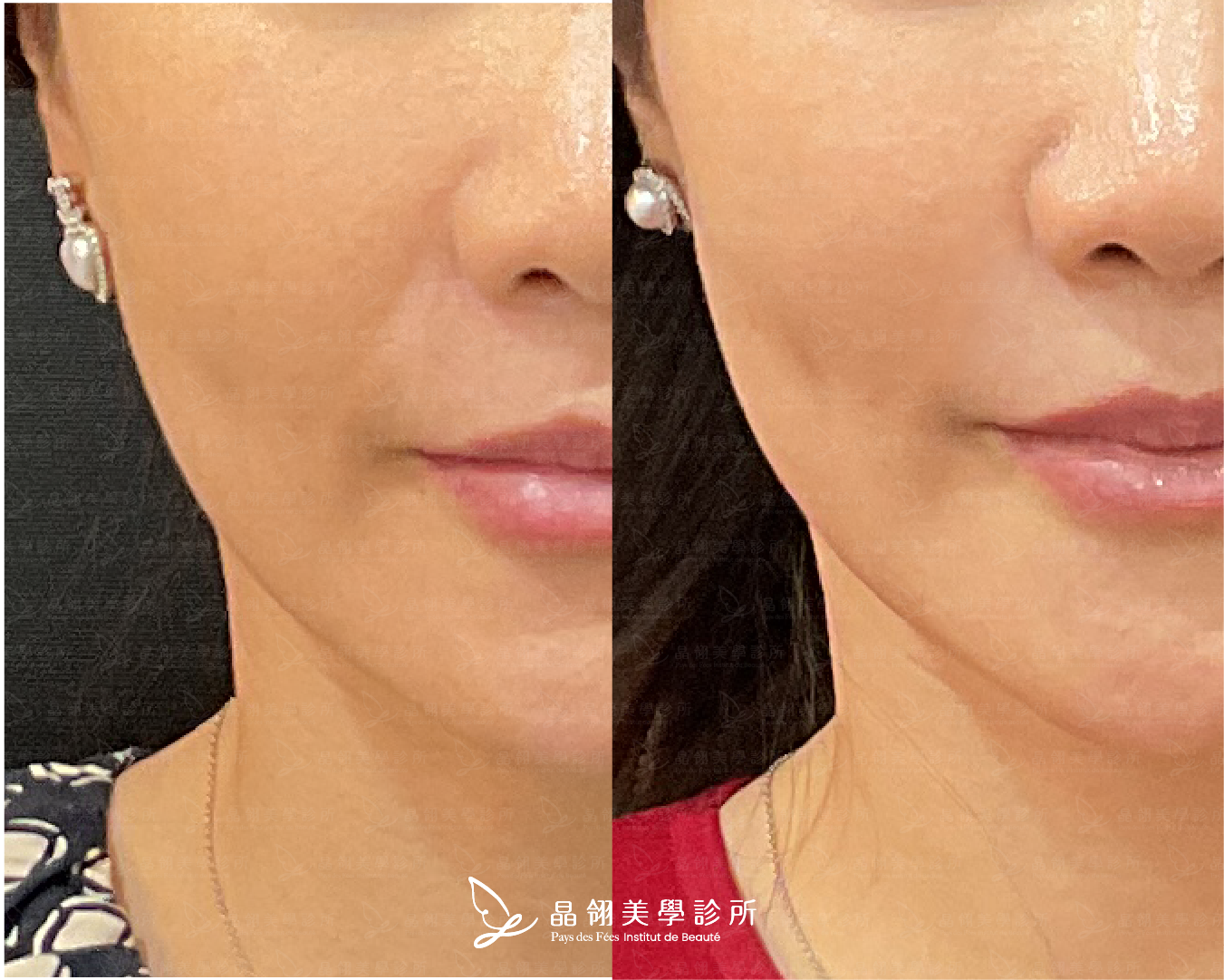 (無雙電波)案例分享-晶翎美學診所-謝綺瀅.png