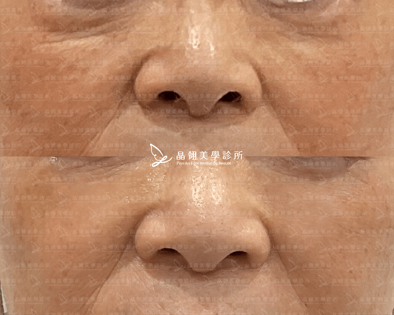 淚溝玻尿酸案例分享-朱女士(晶翎美學診所) 淚溝玻尿酸案例分享-朱女士(晶翎美學診所)