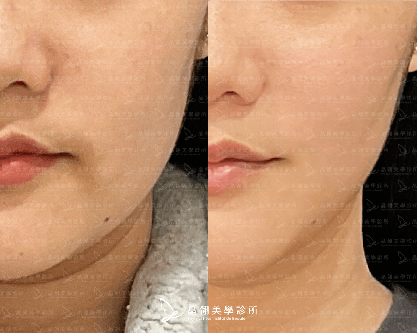 嘴邊肉音波案例分享李小姐(晶翎美學診所) 嘴邊肉音波案例分享李小姐(晶翎美學診所)