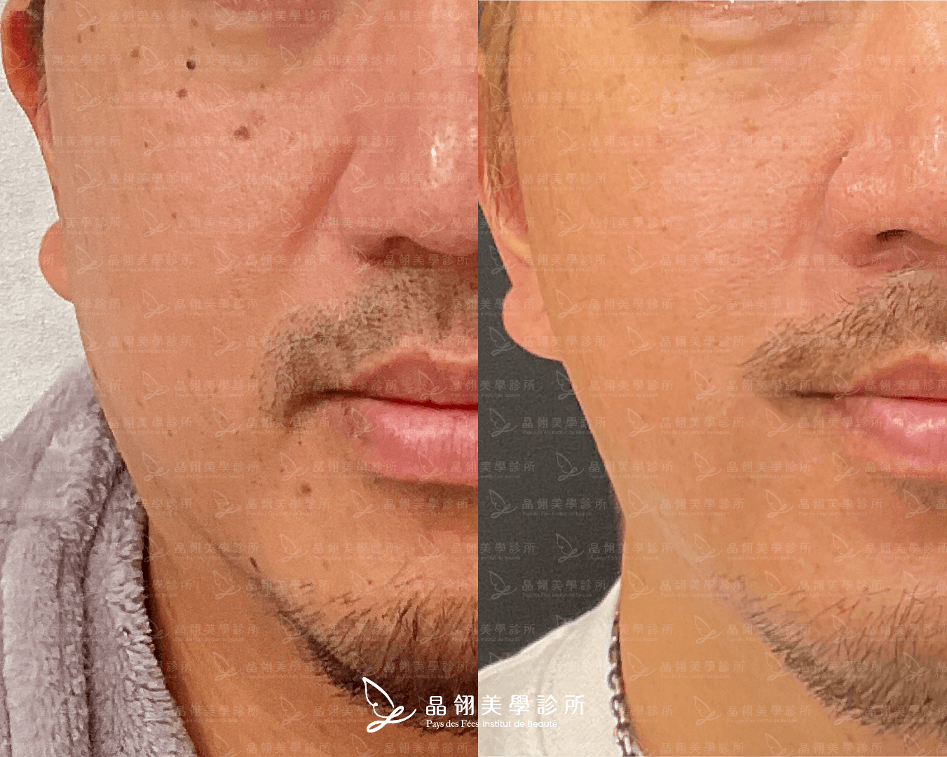 嘴邊肉音波案例分享陳先生(晶翎美學診所) 嘴邊肉音波案例分享陳先生(晶翎美學診所)