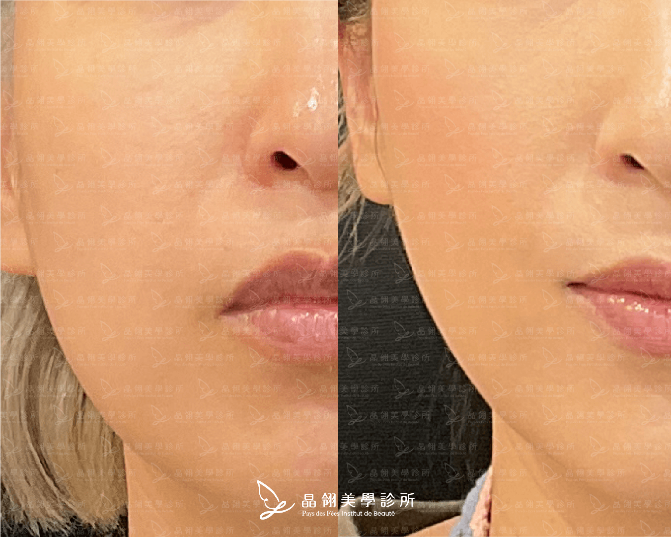 嘴邊肉音波案例分享藍小姐(晶翎美學診所) 嘴邊肉音波案例分享藍小姐(晶翎美學診所)