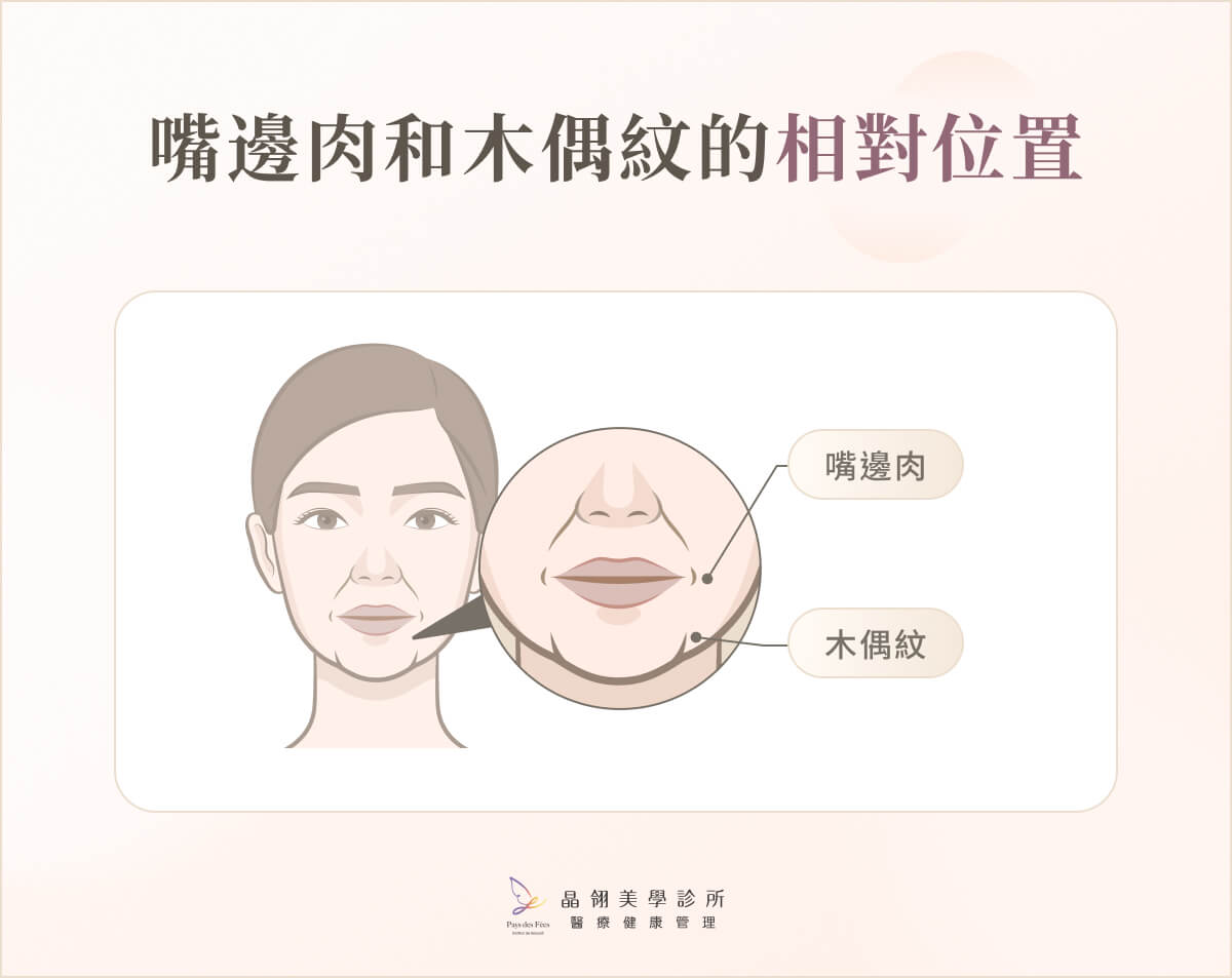 嘴邊肉和木偶紋的相對位置 嘴邊肉和木偶紋的相對位置