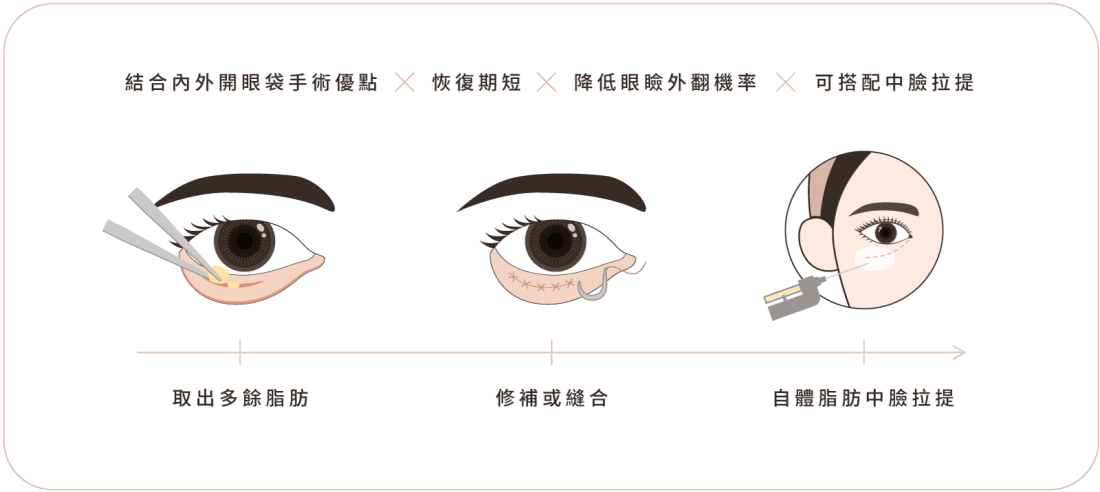 眼袋手術_手術流程.png