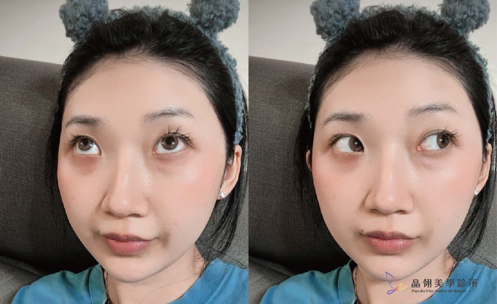 【眼袋手術案例】向無神雙眸說再見!在婚禮前,找回更有精神的自己_工作區域 1 複本.jpg