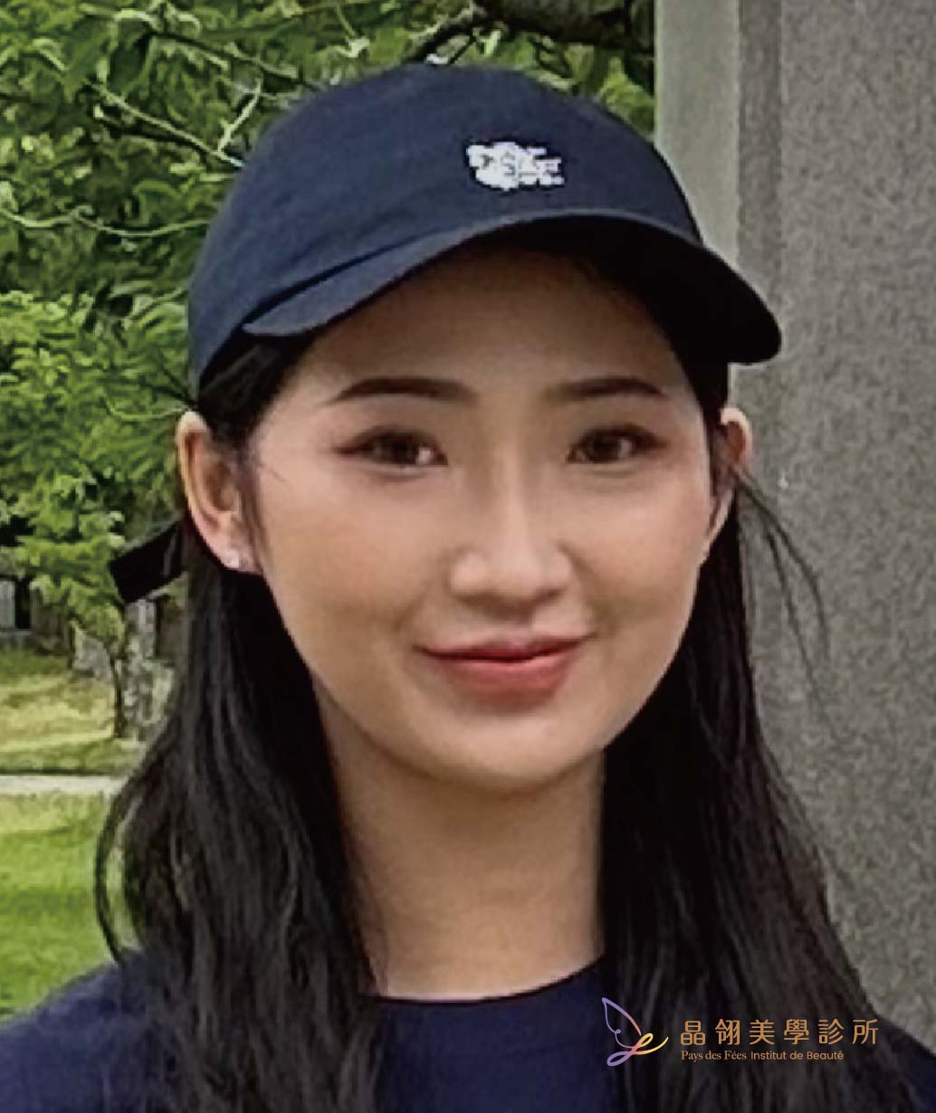 【眼袋手術案例】向無神雙眸說再見!在婚禮前,找回更有精神的自己_工作區域 1 複本 2.jpg