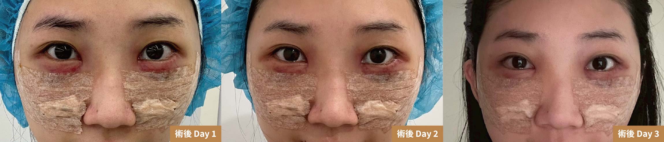 【眼袋手術案例】向無神雙眸說再見!在婚禮前,找回更有精神的自己-08.jpg