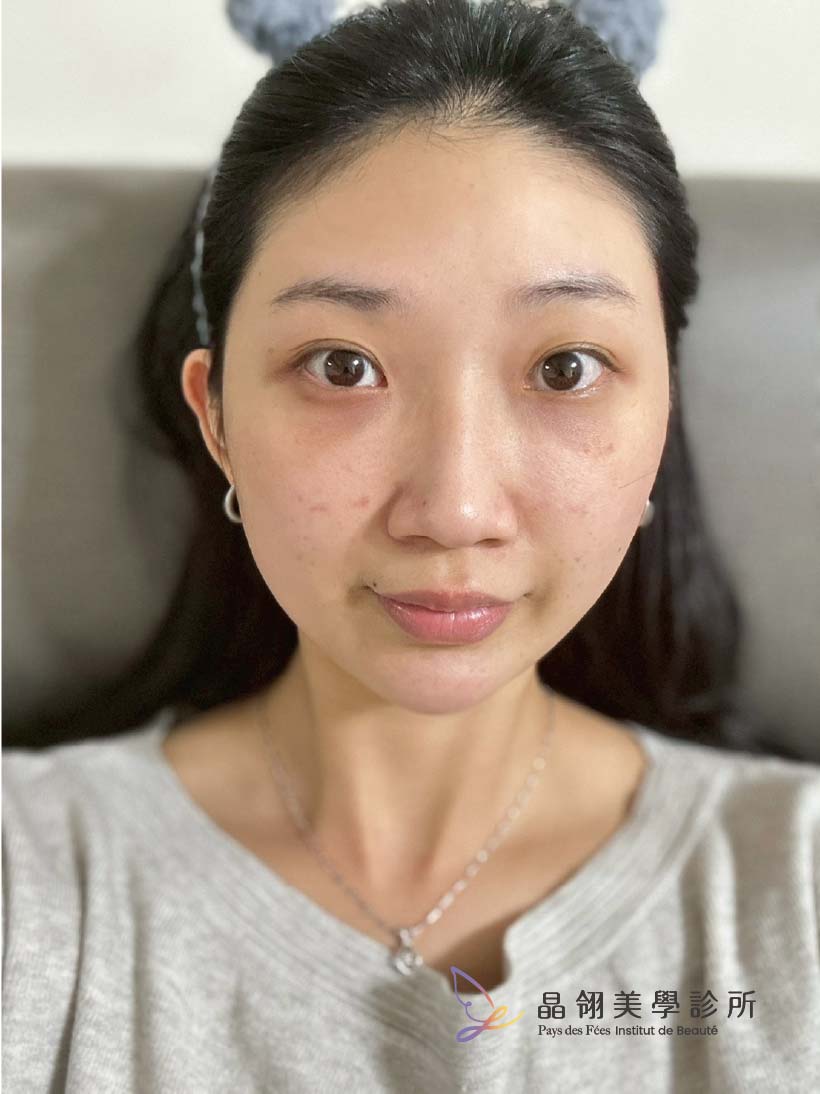 【眼袋手術案例】向無神雙眸說再見!在婚禮前,找回更有精神的自己-10.jpg