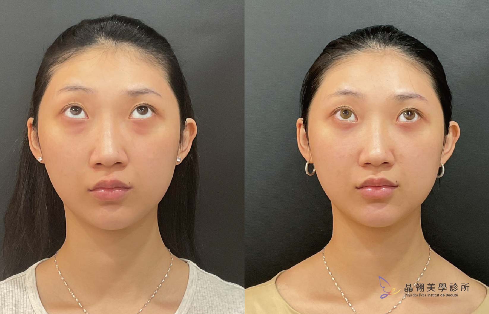 【眼袋手術案例】向無神雙眸說再見!在婚禮前,找回更有精神的自己_工作區域 1 複本 3.jpg
