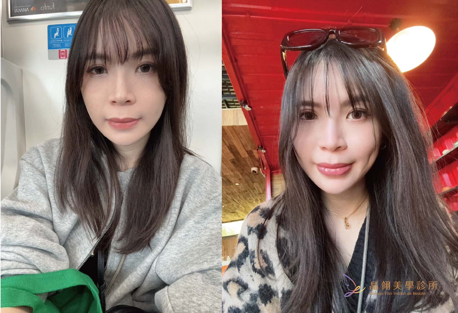 【唇部玻尿酸案例】愛上自然嘟唇的自己,Kysse 唇玻尿酸分享_工作區域 1 複本.jpg