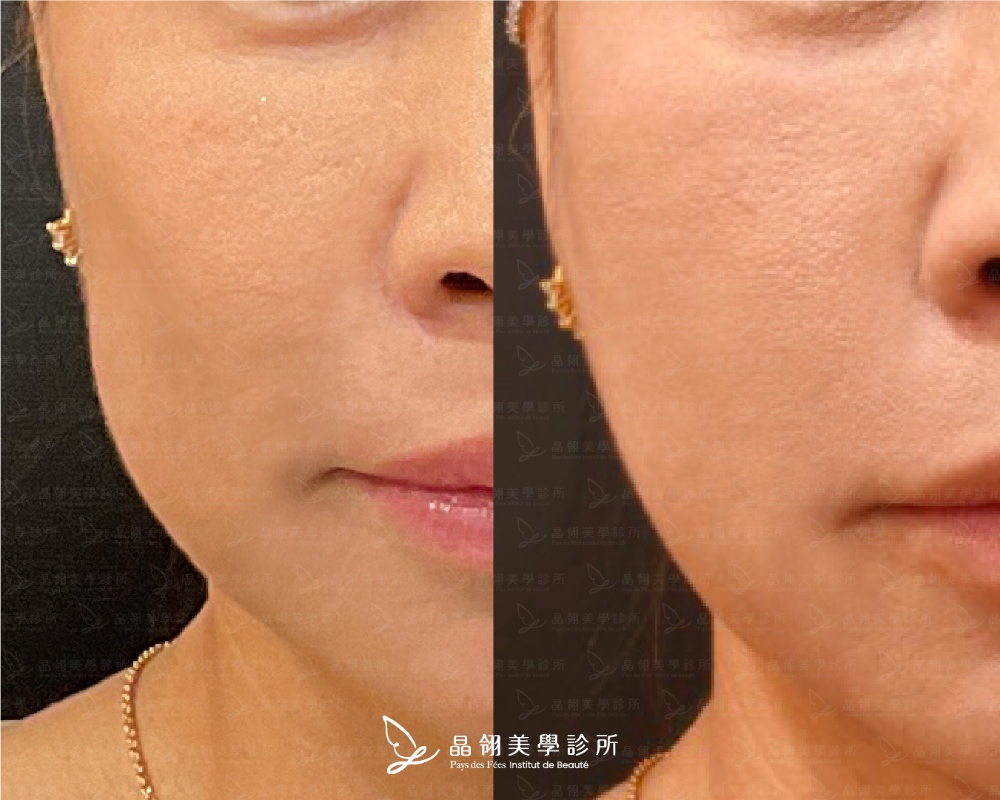 image1.jpg 晶翎美學「逆時針」臉頰凹陷案例