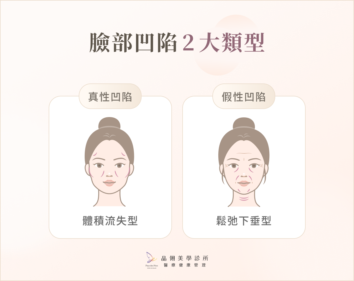臉部凹陷 2 大類型