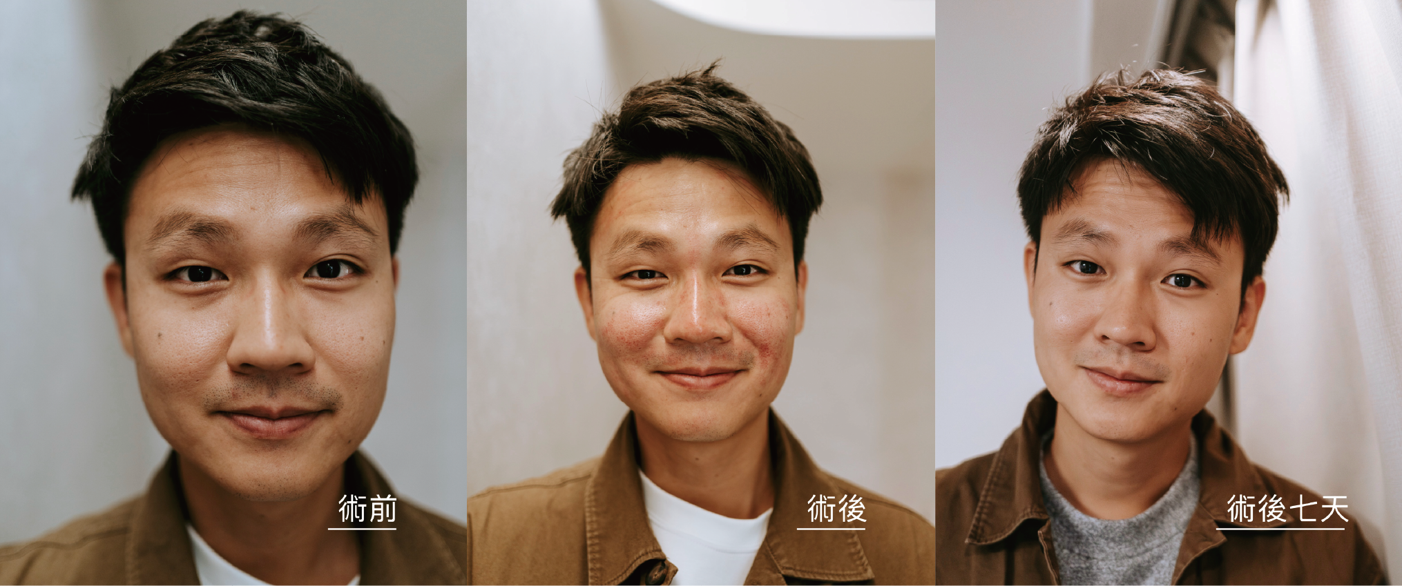 【雙機雷射案例】男生婚前的客製化肌膚保養紀錄_工作區域 1 複本.png