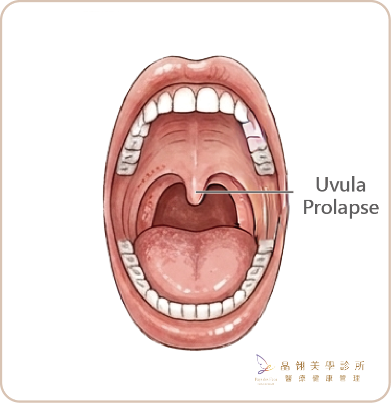 Snoring Laser Treatment-03.png