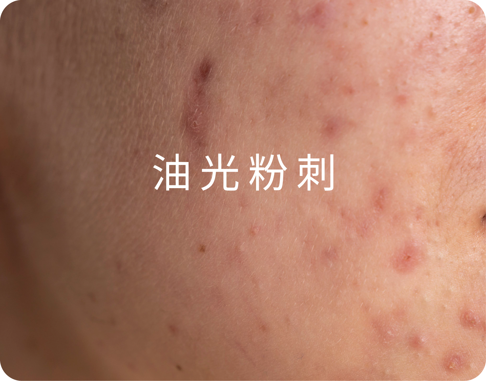 【2026夏季醫美保養全攻略】出油、毛孔、體態大危機?從海菲秀到減脂雷射的終極抗夏指南-03.png